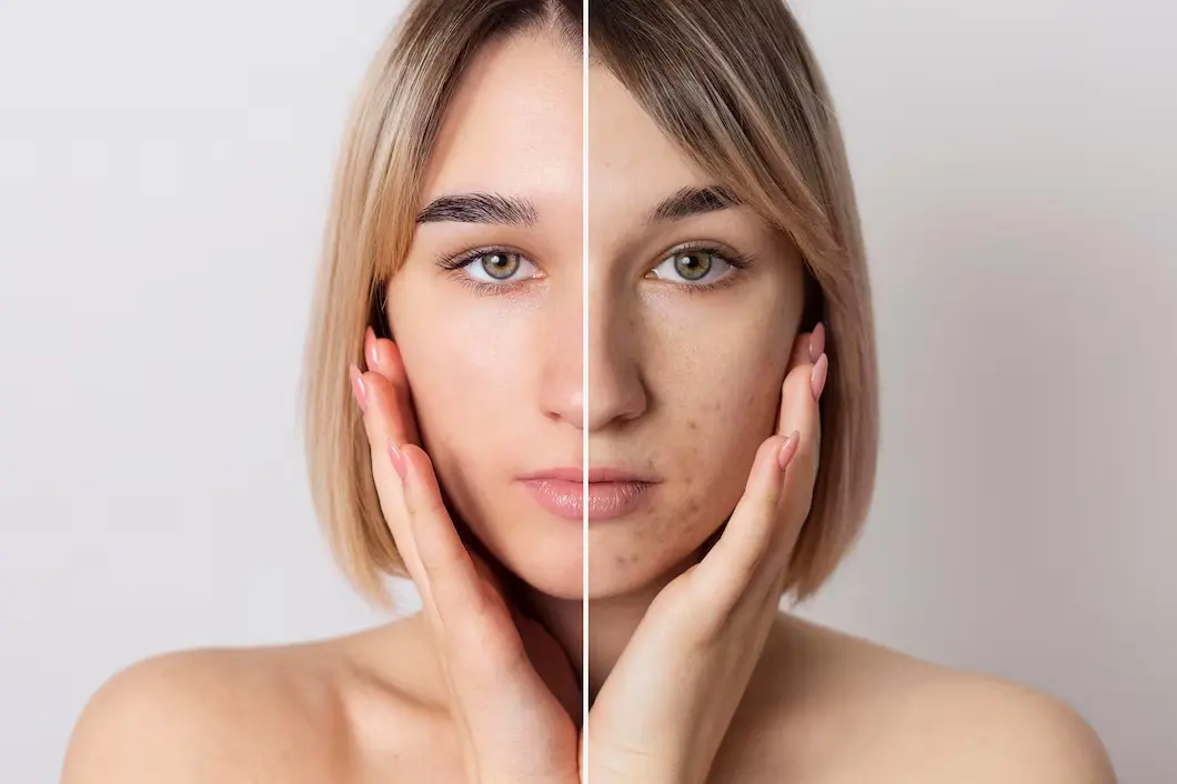 Skin care tips a young girl skin care tips result showing after and before 